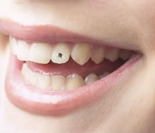 Bild Zahnschmuck